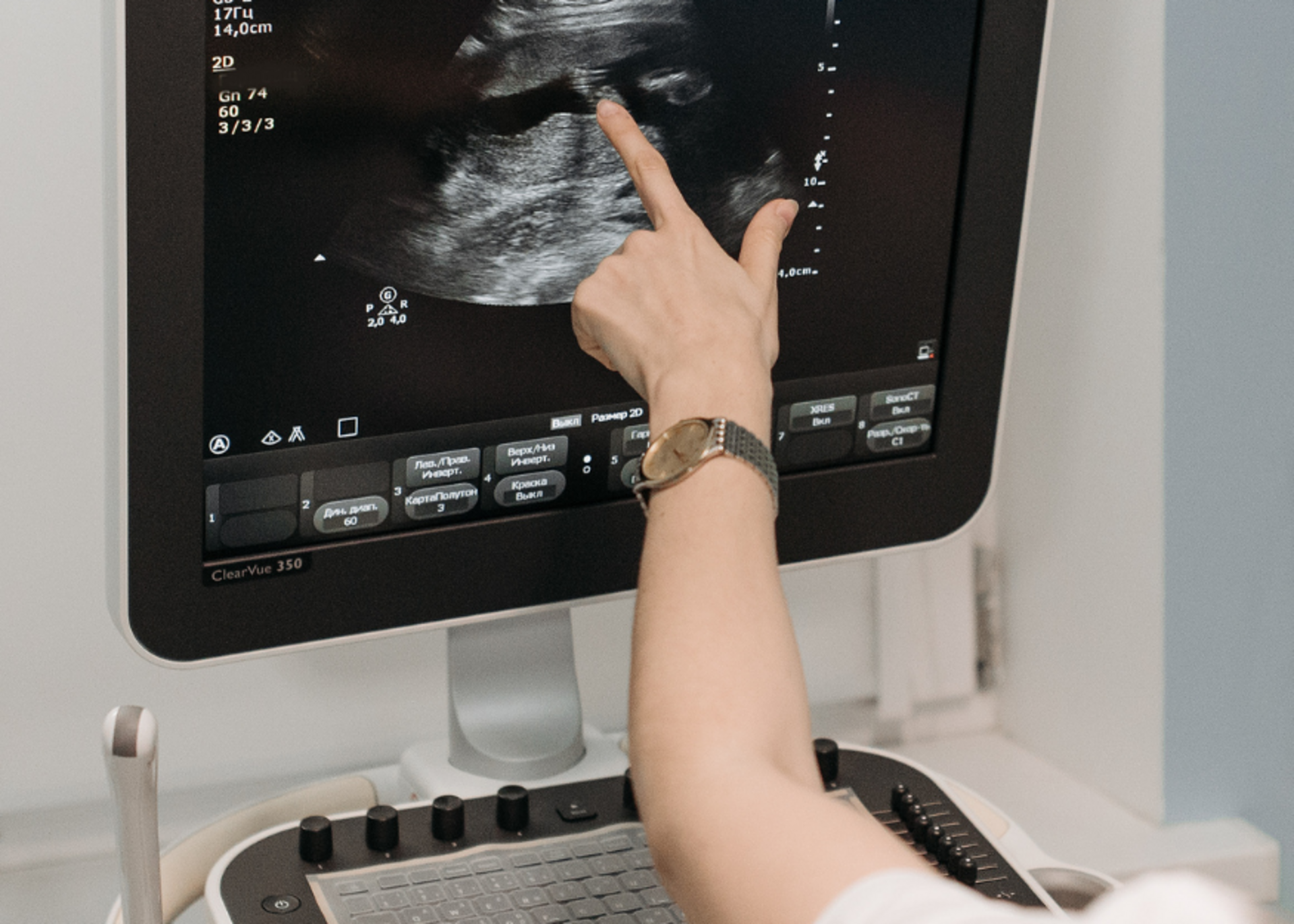 Diagnostic Hysteroscopy